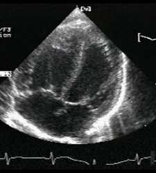 ECOCARDIOGRAMMA